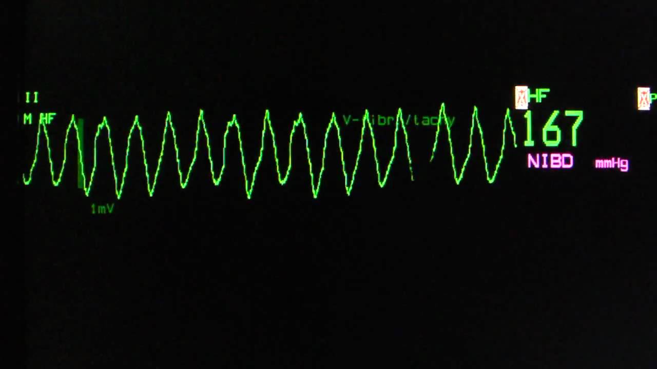VTach EKG Strip